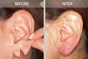 Ear lobe repairing